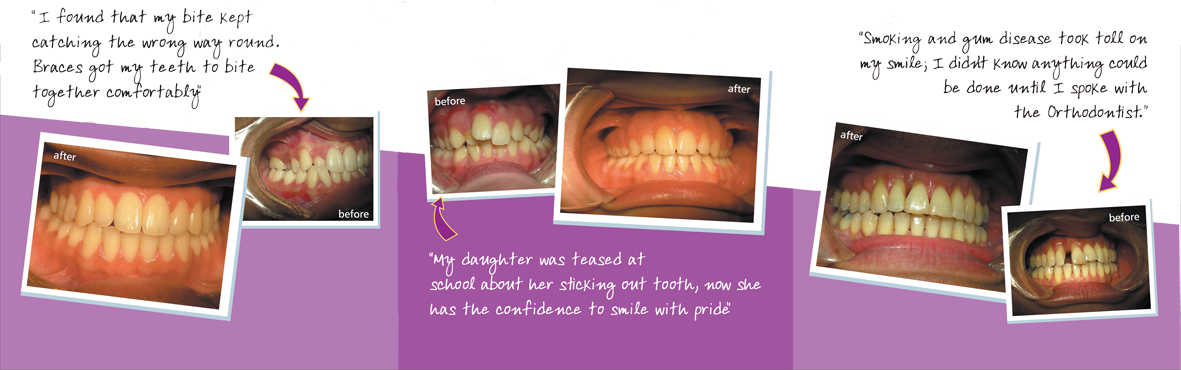 Invisalign Braces London