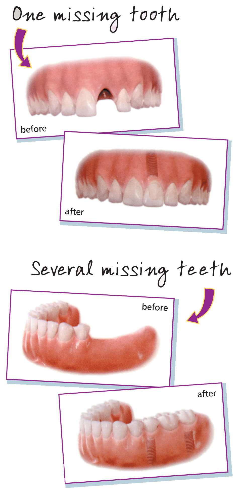 Teeth Implants London